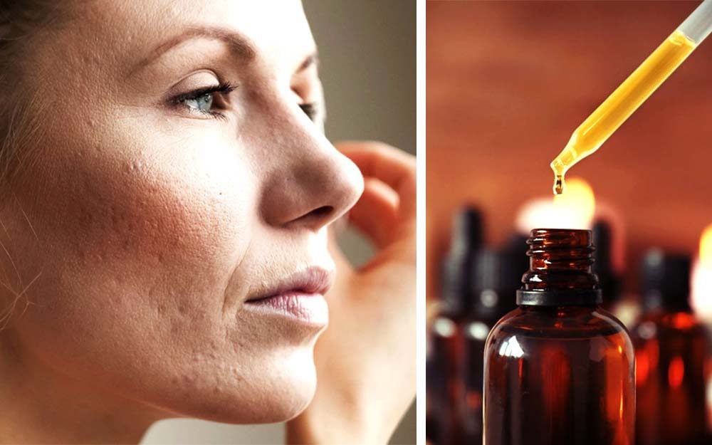 Top 10 Essential Oils For Pimples